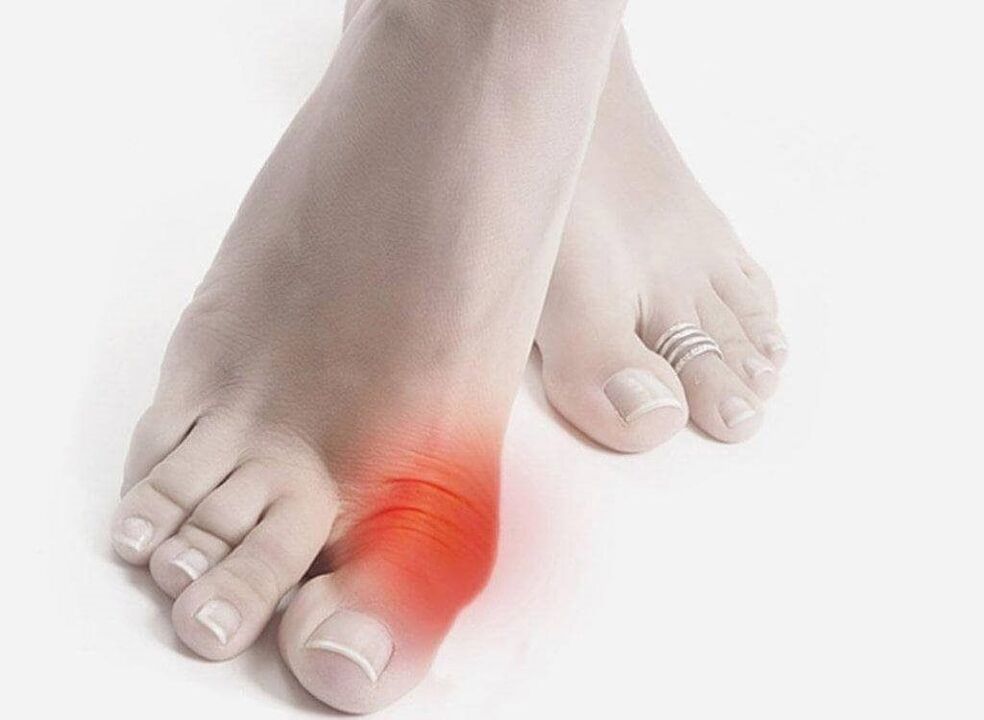 foot symptoms of gout